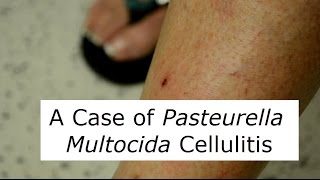 P Multocida Cat Scratch Infection [upl. by Nate]