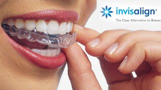 Watch this video before starting INVISALIGN  Starter Kit  Price  Dental Treatment [upl. by Aneet]