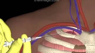 Subclavian Vein Access  Hypovolemic Patient  Animation by Cal Shipley MD [upl. by Anirac]