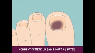 Comment retirer un ongle mort à lorteil [upl. by Yrian]