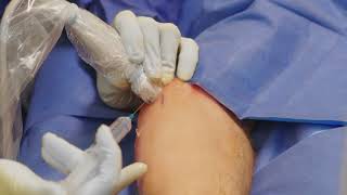 TenJet Medial Epicondylitis Surgical Procedure [upl. by Anij]