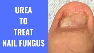 Use Urea To Treat Nail Fungus [upl. by Earal864]