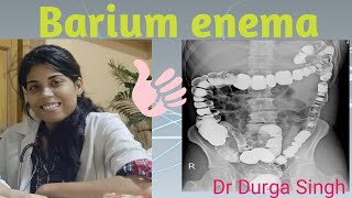 Barium enema  Part 5 in Barium series [upl. by Cockburn]