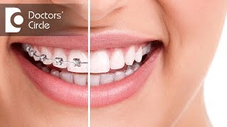 What happens to teeth after the braces are removed  Dr Divyashree Rajendra  Doctors Circle [upl. by Yaf]