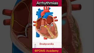 Cardiac Arrhythmia  Arrhythmias overview medicine humanbody [upl. by Evelyn990]