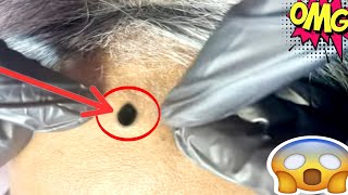 blackheads extractions  blackheads extractions [upl. by Ithnan]