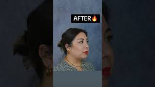 Chin Implant  Chin Lipo RESULTS 🔥 plasticsurgery plasticsurgeon glowup chinimplant chinlipo [upl. by Kirat522]