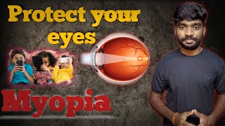 what is myopia  A Complete Guide to Nearsightedness  prashant dhodiya [upl. by Llemart]