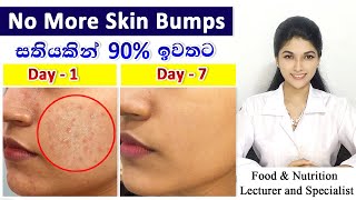 Best Treatment for Oily Skin Bumps with Scientific Explanation  Magical ResultsJust one ingredient [upl. by Thadeus]