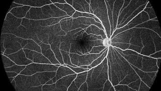 Fundus fluorescein angiography FFA [upl. by Innavoij]