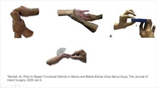 Plastiquest Case Discussion Ulnar Nerve Palsy Part 1 [upl. by Aivilo]