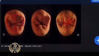 Morphology upper second premolar الضاحك الثاني [upl. by Ailana57]