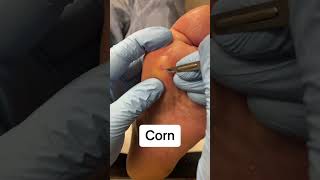 Satisfying corn removal [upl. by Attah]