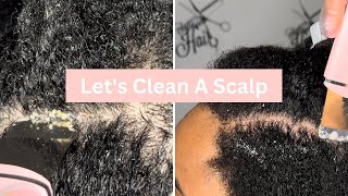 Dandruff Treatment At Home  Dandruff Removal  Flaky Scalp [upl. by Tsepmet]