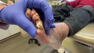 Unbelievable long painful toenails part 2 [upl. by Oivaf]