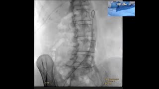 Hemorrhoid Embolization Live Case Recording [upl. by Ait64]