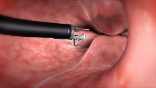 What Happens During the Endoscopic Sleeve Gastroplasty ESG Procedure [upl. by Eybba813]