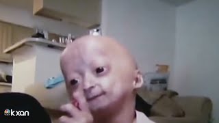 Adalia Rose Austinite social media star with rare genetic condition dies at 15 [upl. by Enerahs1]