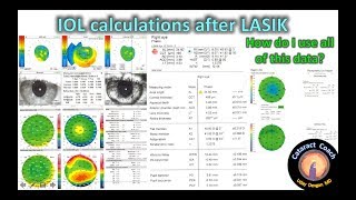 Methods for IOL calculations for Cataract Surgery after prior LASIK [upl. by Rosaleen]