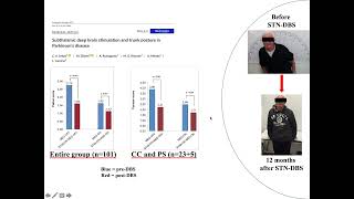 Trunk postural abnormalities and DBS by Carlo Alberto Artusi [upl. by Imij]