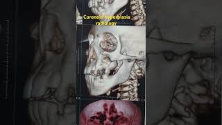 coronoid hyperplasia radiology by dr Mohamed Hasan Osman shorts maxillofacial [upl. by Allebram]