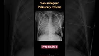 Noncardiogenic Pulmonary Edema Differential Diagnosis shorts radiologyshorts [upl. by Dranal]