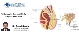 Tail bone pain Coccygeal block Ganglion Impar block  Dr Achal Gupta  Neuro amp Spine Surgeon [upl. by Ferne]