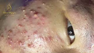 Loan Nguyen Acne Treatment 358pre [upl. by Aiela]