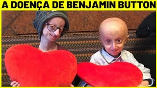 O QUE É PROGERIA SINTOMAS CAUSAS E TRATAMENTO [upl. by Kavita]