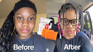 I USED KOJIC ACID SOAP FOR 2 WEEKS… [upl. by Ermanno745]