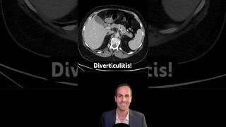 Abdominal CT Tutorials  Diverticulitis [upl. by Gnilyam]