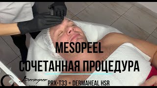 Мезопил Сочетанная процедура PRXT33 и фракционная мезотерапия от Dermaheal HSR и DP2M с подачей [upl. by Guimond442]