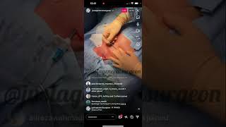 Inside the OR with justageneralsurgeon  livestream port placement chemotherapy cancer central line [upl. by Claude307]