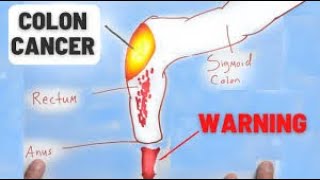 Four Crucial Signs of Colon Cancer Dont Overlook [upl. by Weksler492]