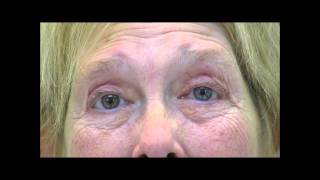 VIMPAT Blepharospasm Hemifacial Spasm Testimonial 2 [upl. by Umberto]