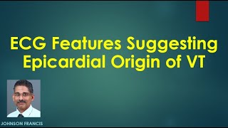 ECG Features Suggesting Epicardial Origin of VT [upl. by Enimzzaj321]