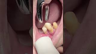 Extraction of upper first premolar tooth with mobility dentist smilteethcare teethwhitening [upl. by Lorain]