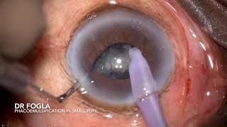 Phacoemulsification in an eye with non dilating small pupil [upl. by Drewett189]