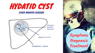 Hydatid Cyst [upl. by Guod]