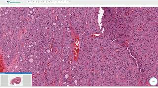 Oncocytic Hürthle Cell Adenoma  Thyroid Gland Histopathology [upl. by Rocray]