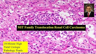 MiT Family Translocation Renal Cell Carcinoma [upl. by Banks]