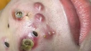 Big Cystic Acne Blackheads Extraction Blackheads amp Milia Whiteheads Removal Pimple Popping  427 [upl. by Priscilla]