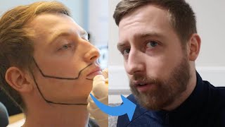 Beard Transplant  Jay´s Complete journey to a Full Beard before  after [upl. by Bogoch]