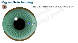 Demonstration of Kayser Fleischer Ring Dept of Medicine JNMC [upl. by Yasnil]