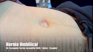 HERNIA ABDOMINAL  Qué es qué afecta síntomas signos clínicos y tratamiento fisioterapéutico [upl. by Nairret]