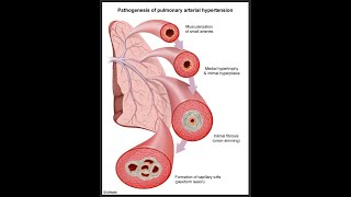 Pulmonary hypertension for the boards [upl. by Comfort269]