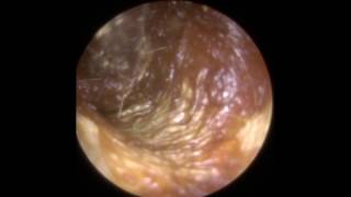 Ear Wax Removal in Twisty Narrow and Hairy Ear Canal  Mr Neel Raithatha The Hear Clinic [upl. by Postman454]