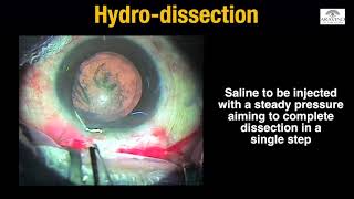 Episode 3  Hydroprocedures in MSICS [upl. by Weiler875]