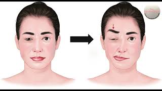 Treatment of Hemifacial Spasm amp Benign Essential Spasm with Botulinum Toxin Injections in India [upl. by Efi495]