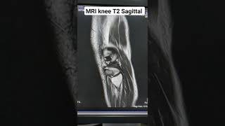 MRI Knee T2WEIGHTED image sagittal View Section MRI Knee imaging Techniques for beginners [upl. by Ztnarf739]